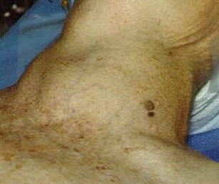 THYROID GOITER