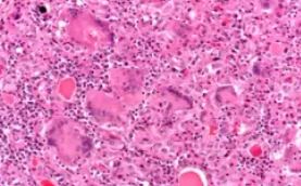 GRANULOMATOUS THYROIDITIS