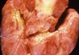 GRAVES DISEASE