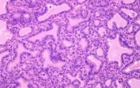 GRAVES DISEASE 