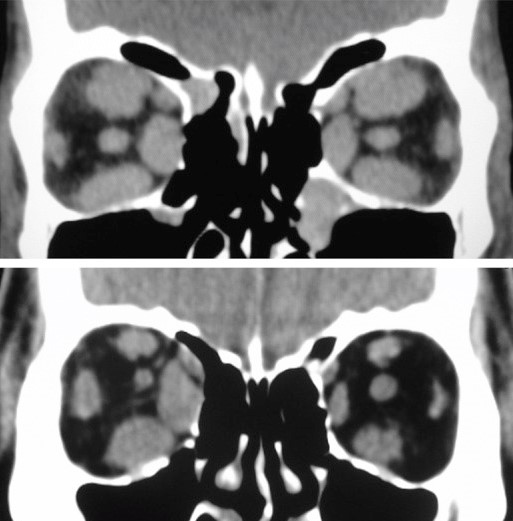 GRAVES' ORBITOPATHY