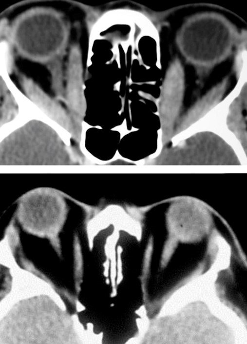 GRAVES' ORBITOPATHY