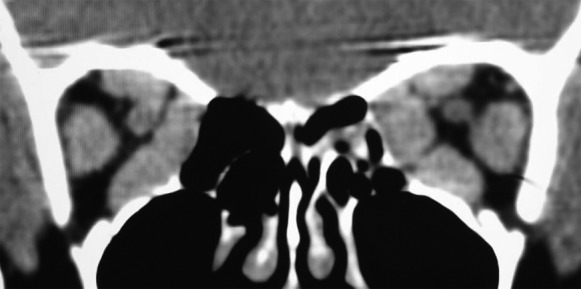 GRAVES' ORBITOPATHY
