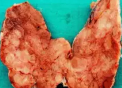 HASHIMOTO THYROIDIDTIS