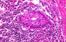 HASHIMOTO'S THYROIDITIS
