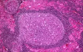 HASHIMOTO'S THYROIDITIS