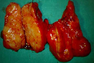 HASHIMOTO'S THYROIDITIS