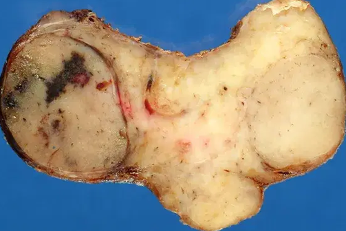 HASHIMOTO THYROIDITIS WITH A DOMINANT NODULE