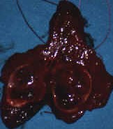 HURTHLE CELL THYROID CARCINOMA