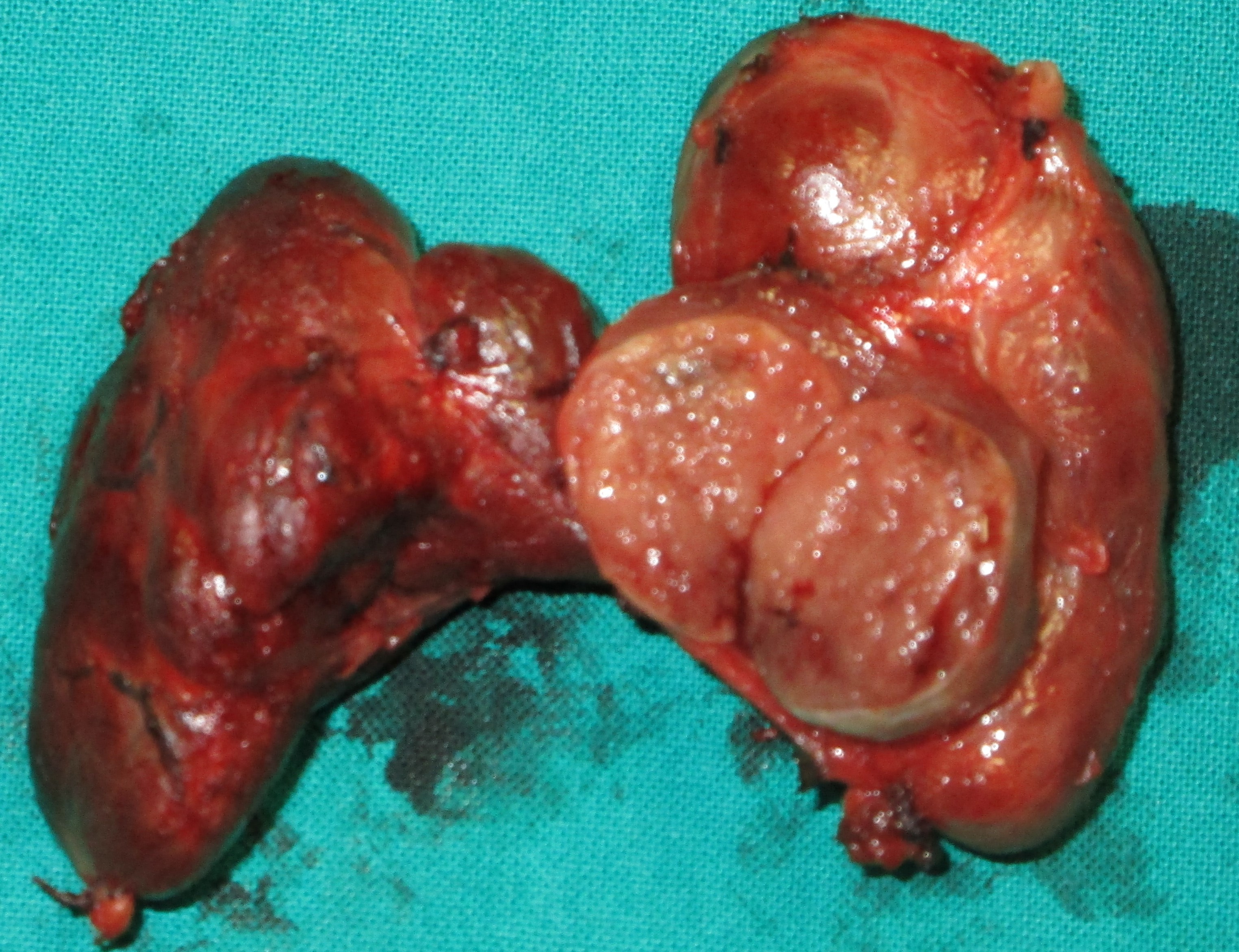 HASHIMOTO'S THYROIDITIS