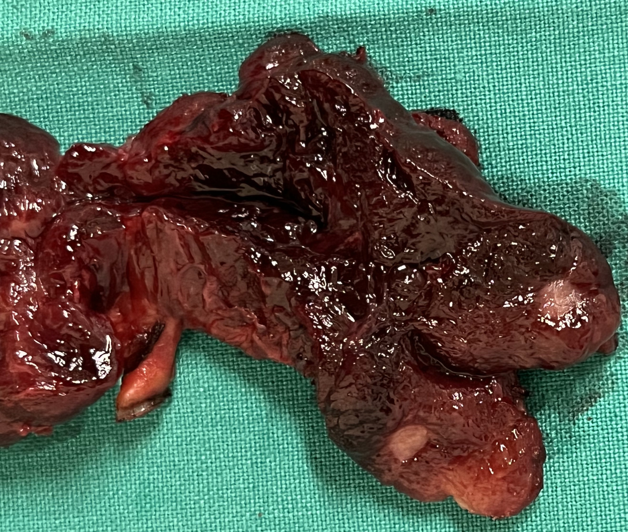 PAPILLARY THYROID CARCINOMA