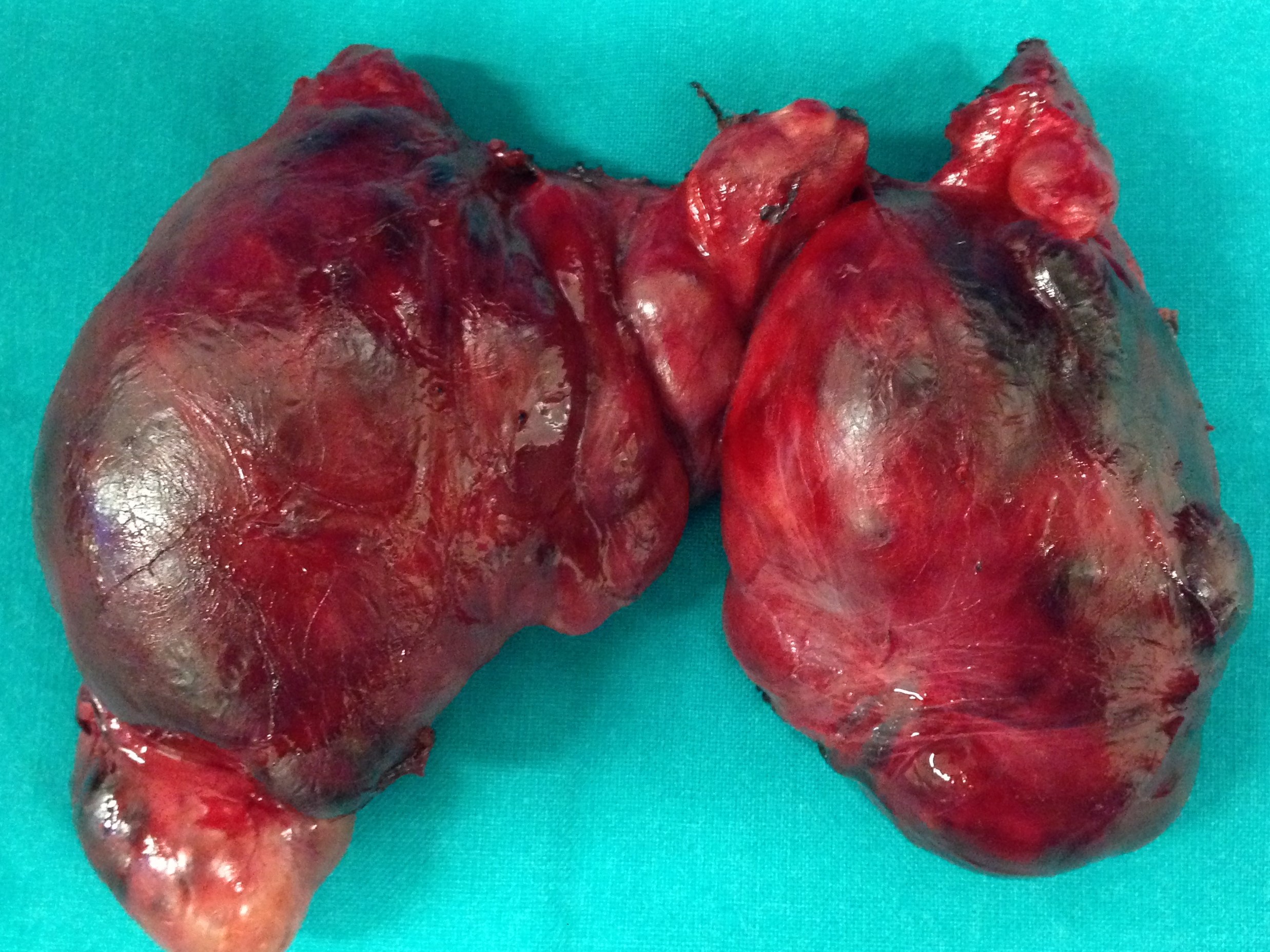 HASHIMOTO'S THYROIDITIS