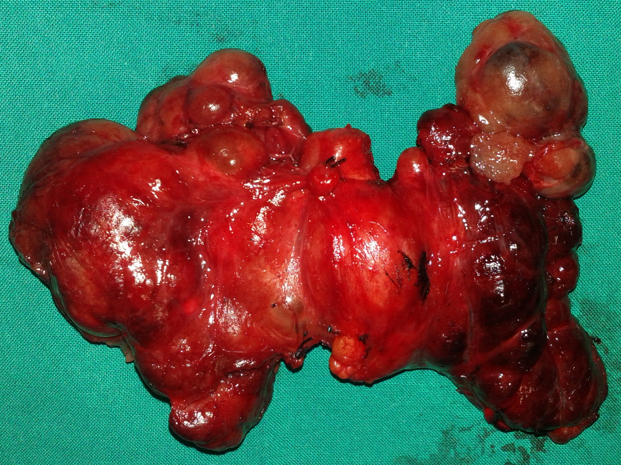 THYROID GOITER