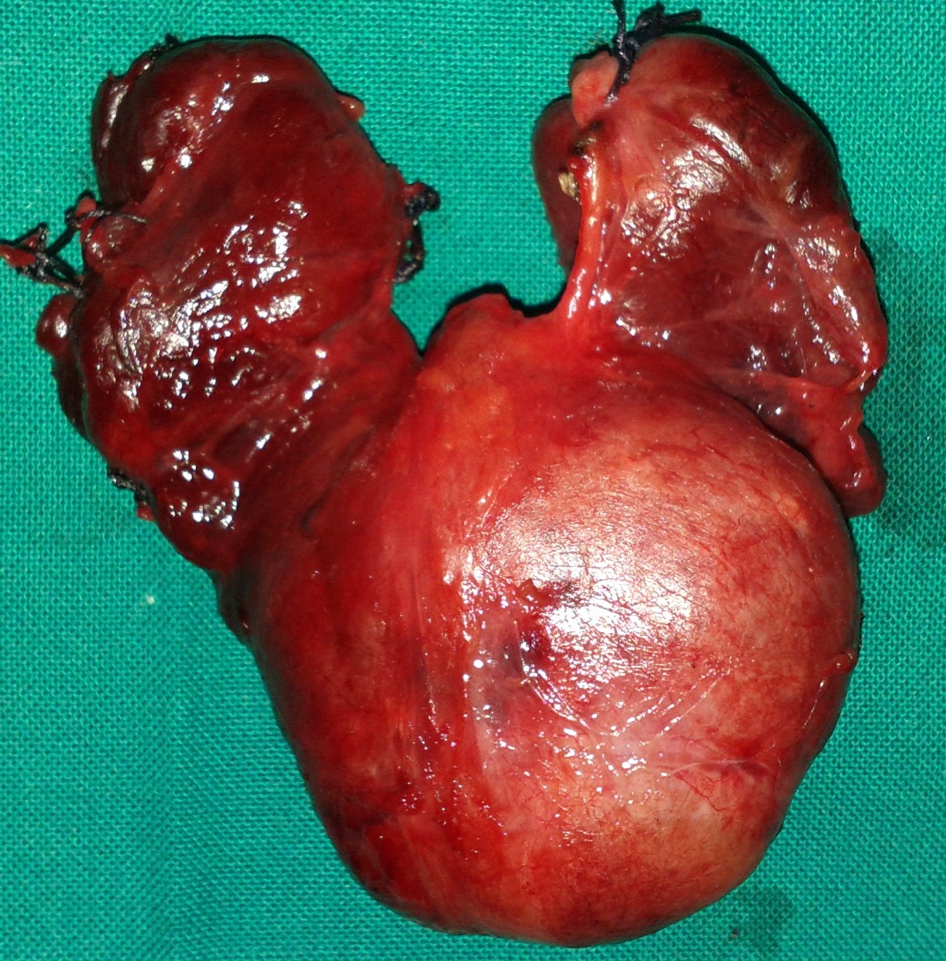 THYROID GOITER