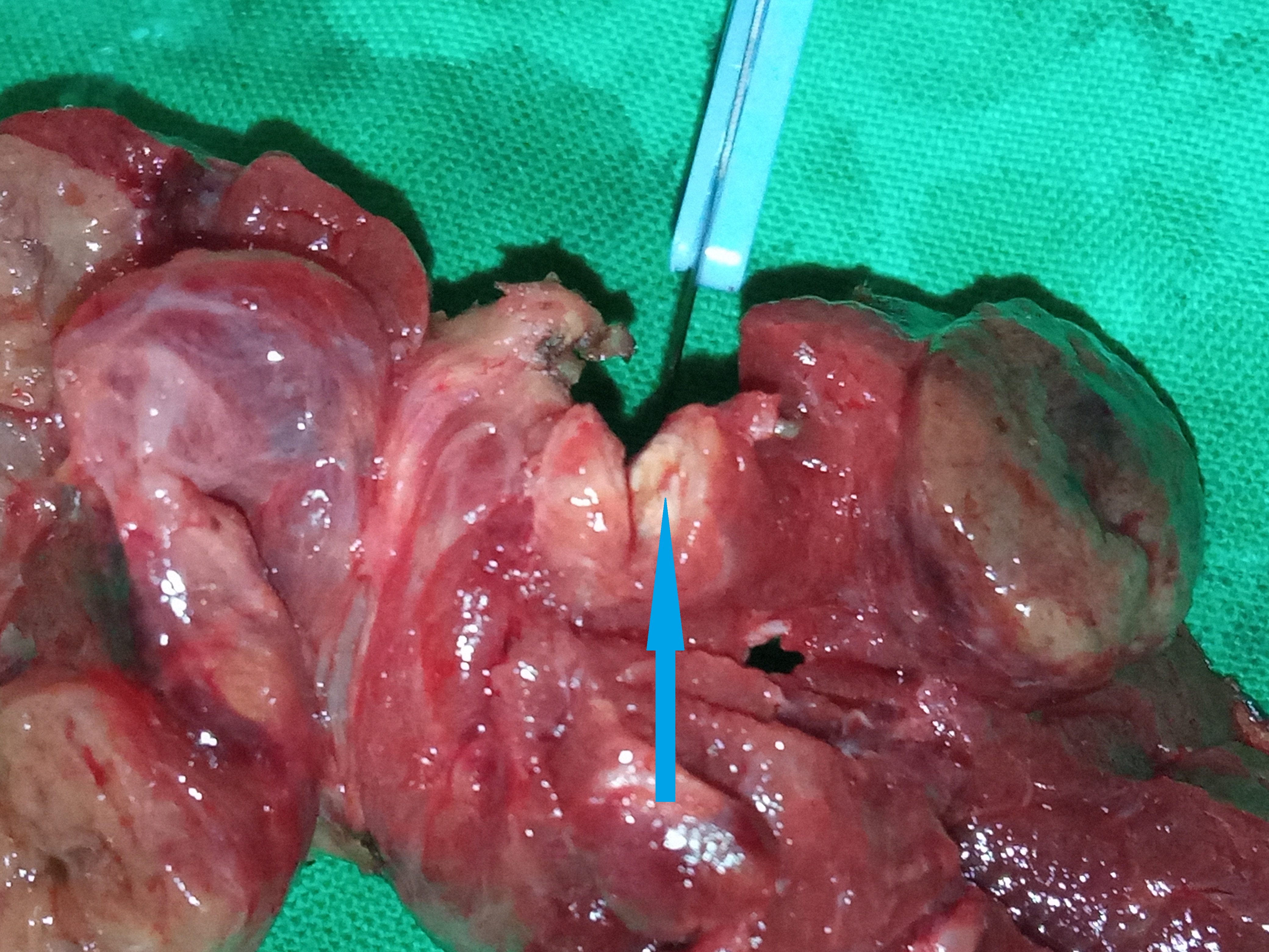 PAPILLARY THYROID CARCINOMA
