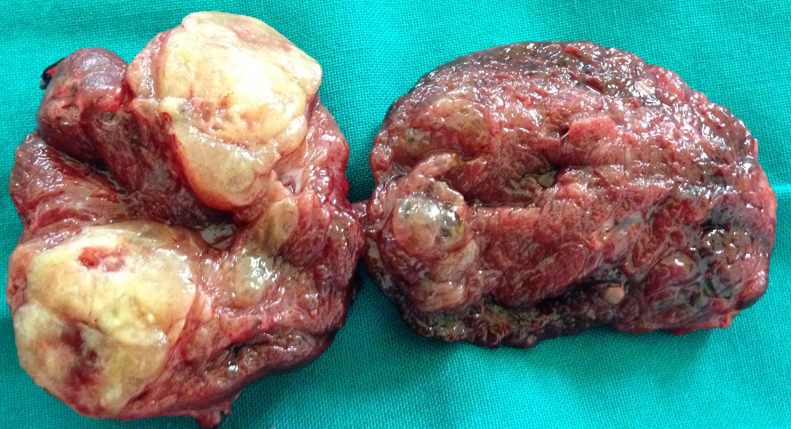 THYROID ADENOMA