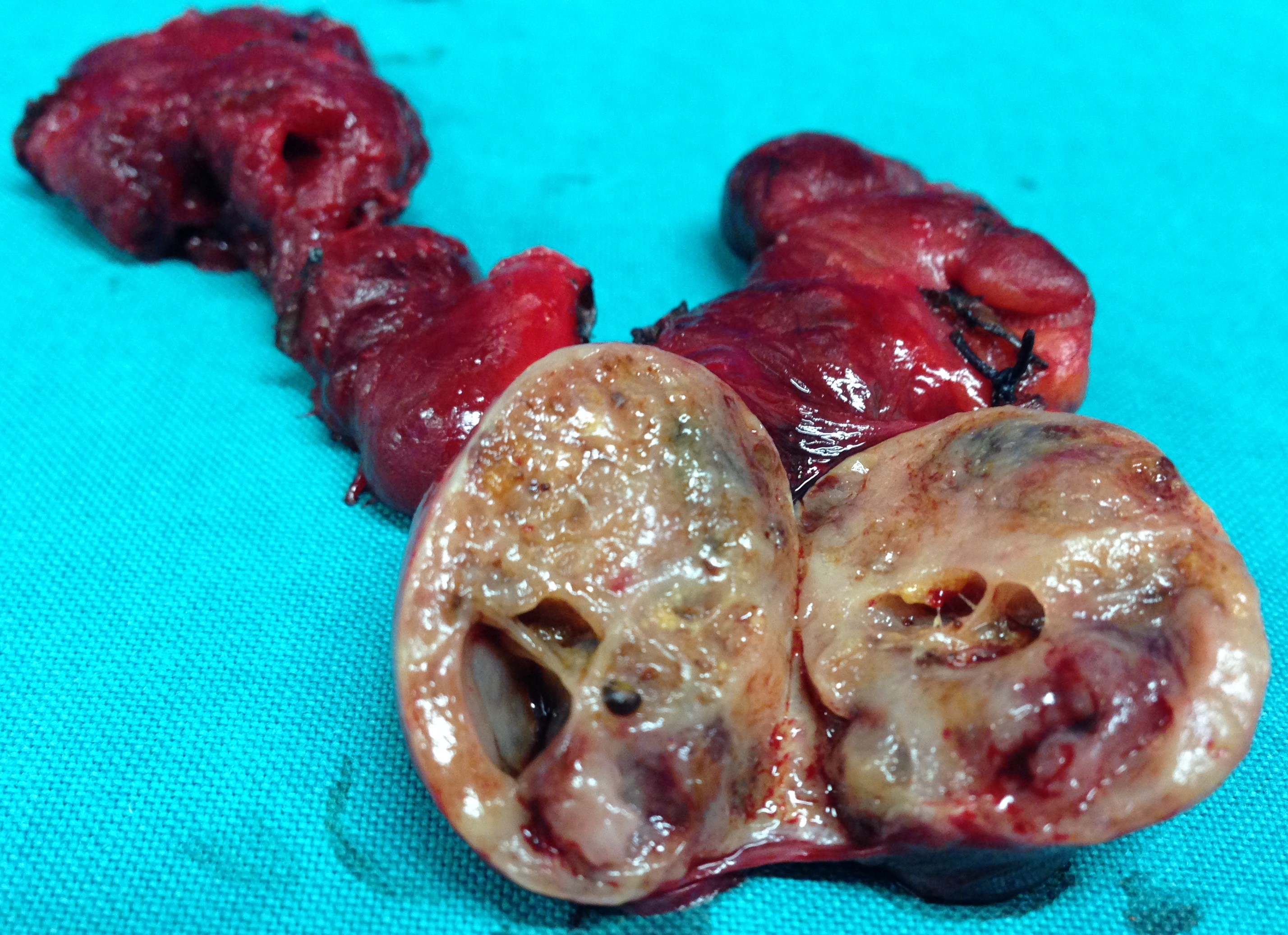 CYSTIC DEGENERATION THYROID LOBE