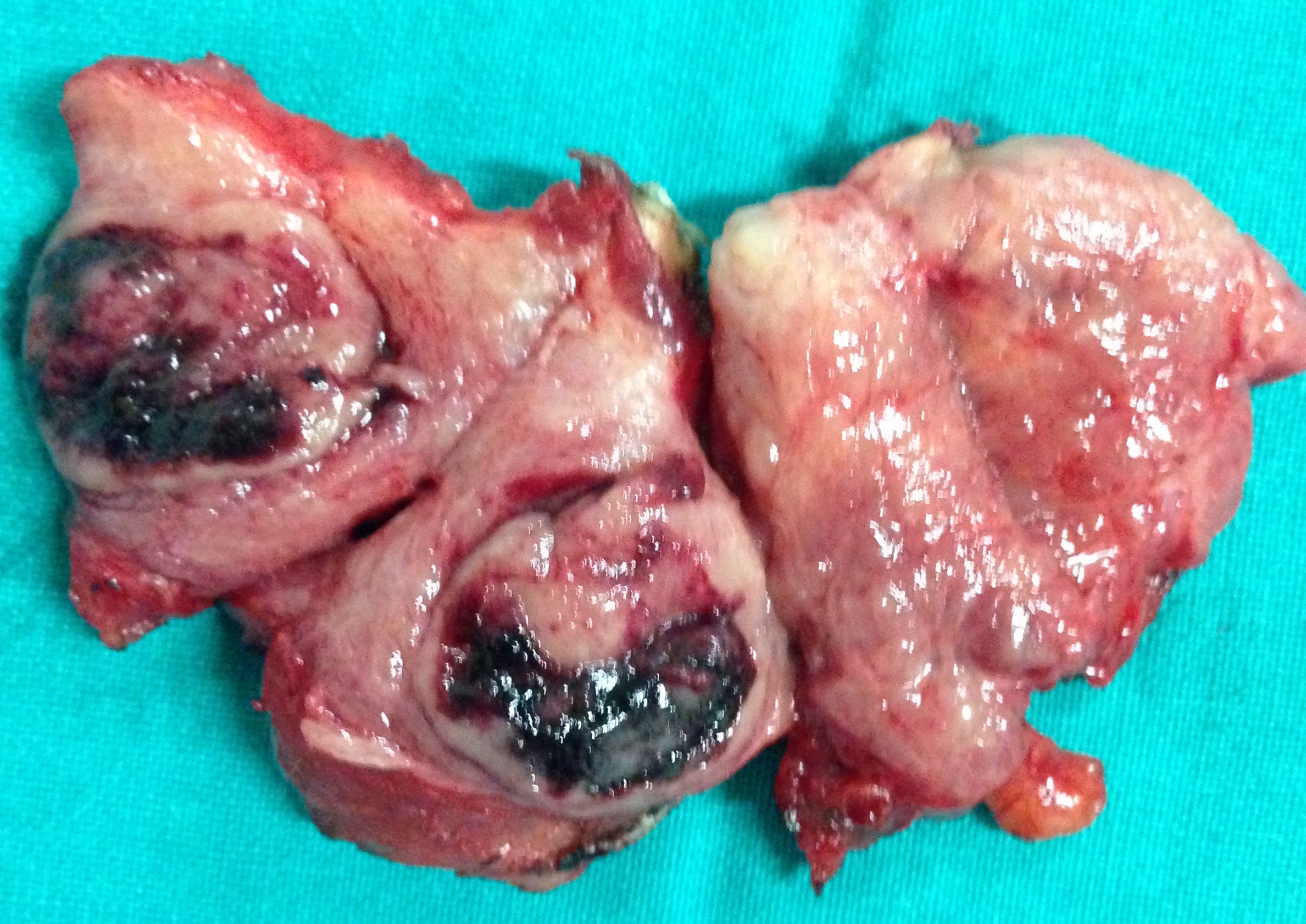 INTRACYSTIC HEMORRHAGE