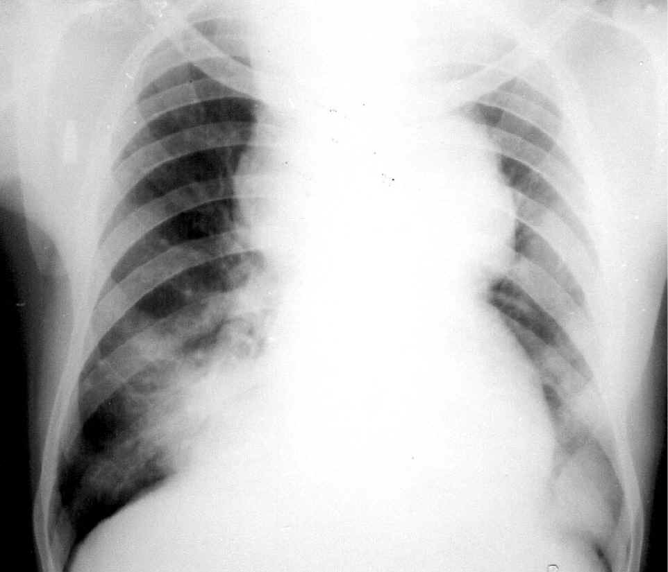 INTRATHORACIC GOITER