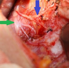 NON RECURRENT INFERIOR LARYNGEAL NERVE