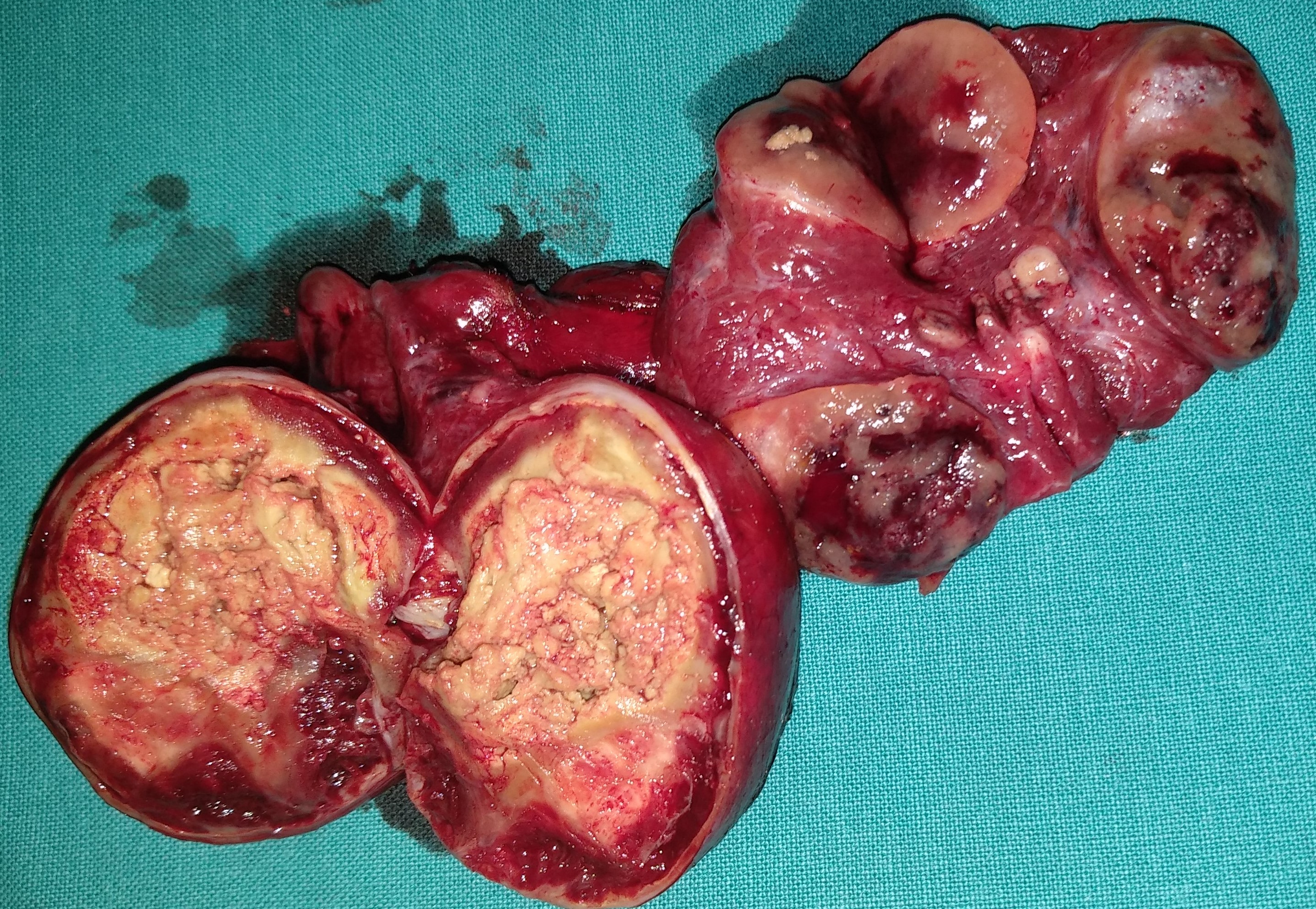 MEDULLARY THYROID CARCINOMA