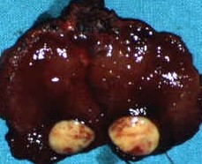 MEDULLARY THYROID CARCINOMA