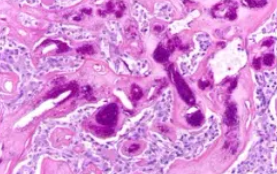 MEDULLARY THYROID CARCINOMA