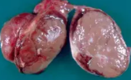 MEDULLARY THYROID CARCINOMA