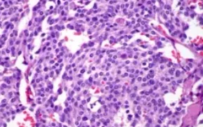 MEDULLARY THYROID CARCINOMA