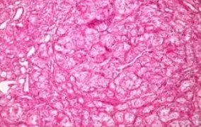 MEDULLARY THYROID CARCINOMA 