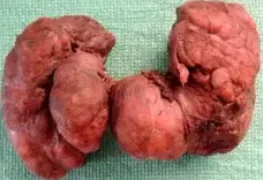 MULTINODULAR GOITER 