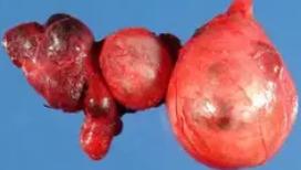 MULTINODULAR GOITER