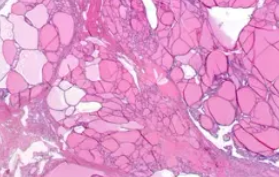 MULTINODULAR GOITER