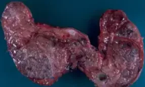MULTINODULAR GOITER 