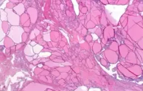 MULTINODULAR GOITER 