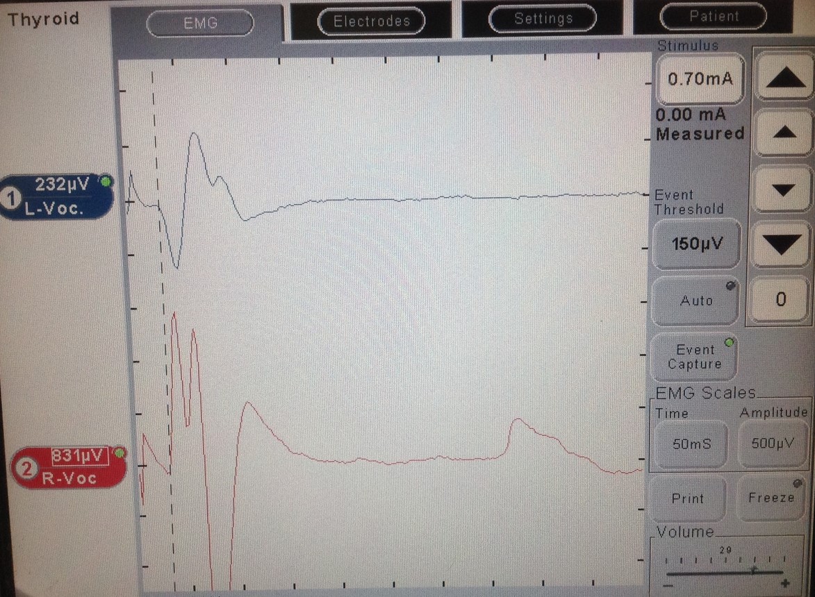 INTRAOPERATIVE RECORDING LARYNGEAL NERVES DYNAMICS