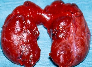 HASHIMOTO'S THYROIDITIS