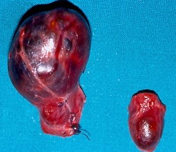 BENIGN "COLD" THYROID NODULES