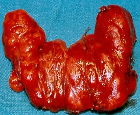 MULTINODULAR GOITER
