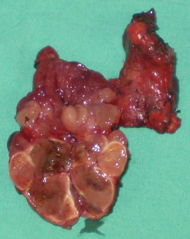 BENIGN "COLD" THYROID NODULES