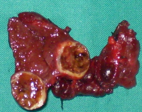 BENIGN "COLD" THYROID NODULE