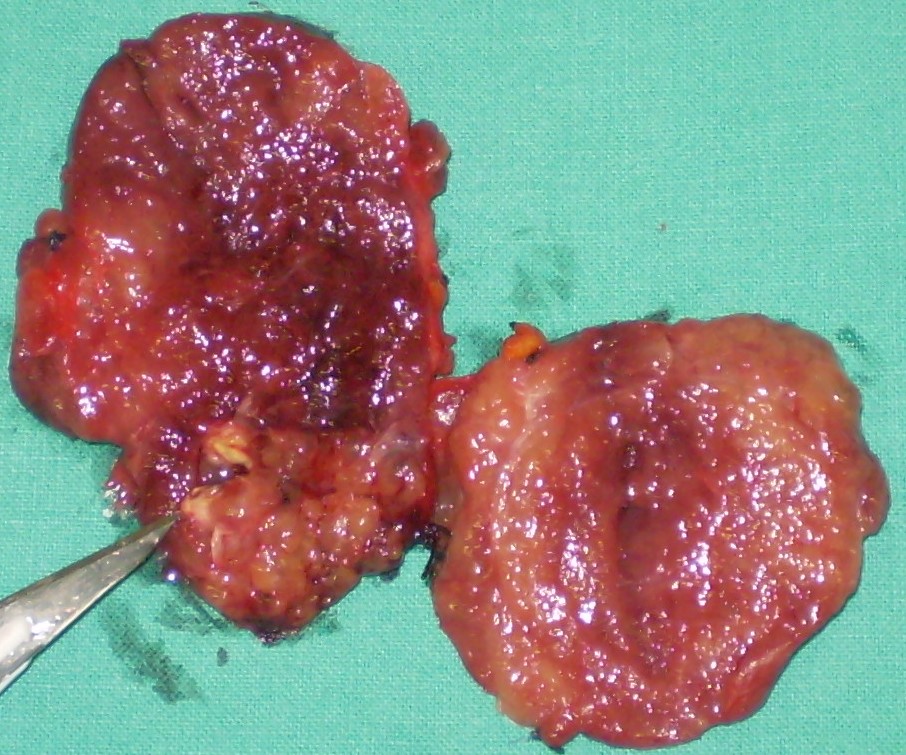 PAPILLARY THYROID CARCINOMA