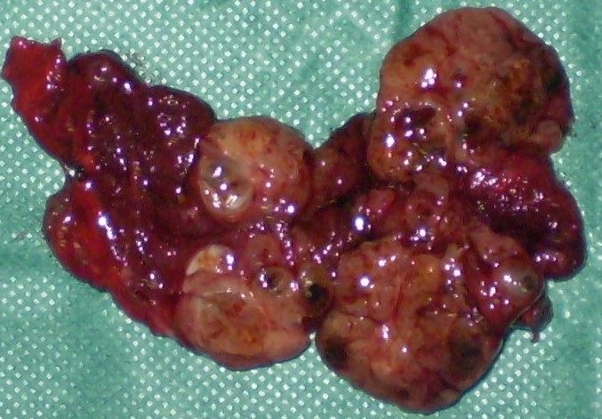 BENIGN "COLD" THYROID NODULES