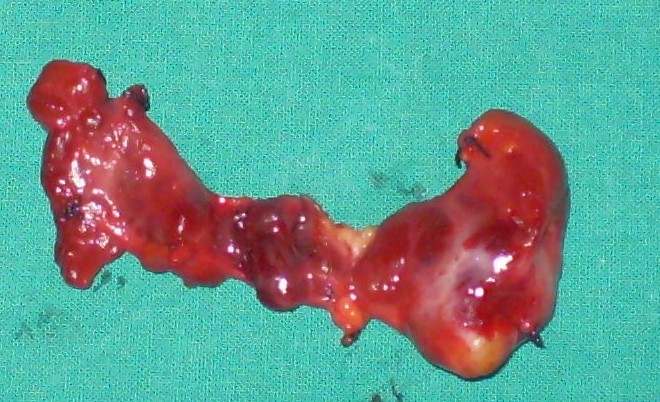 PAPILLARY THYROID MICROCARCINOMA