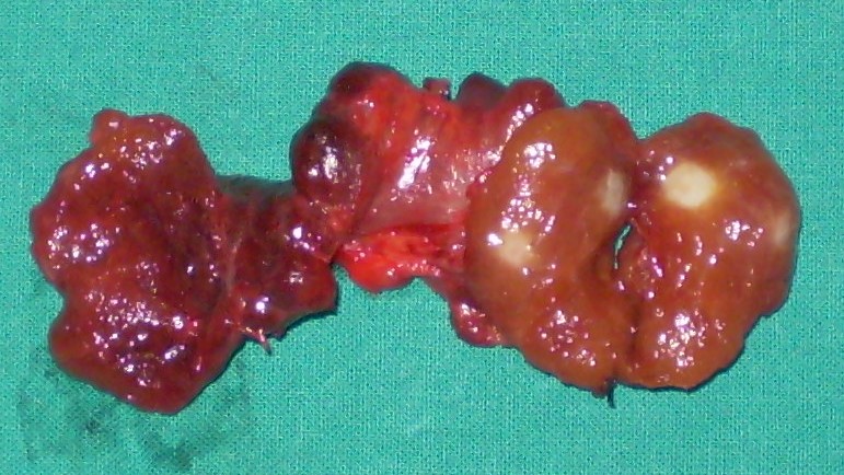 PAPILLARY THYROID CARCINOMA