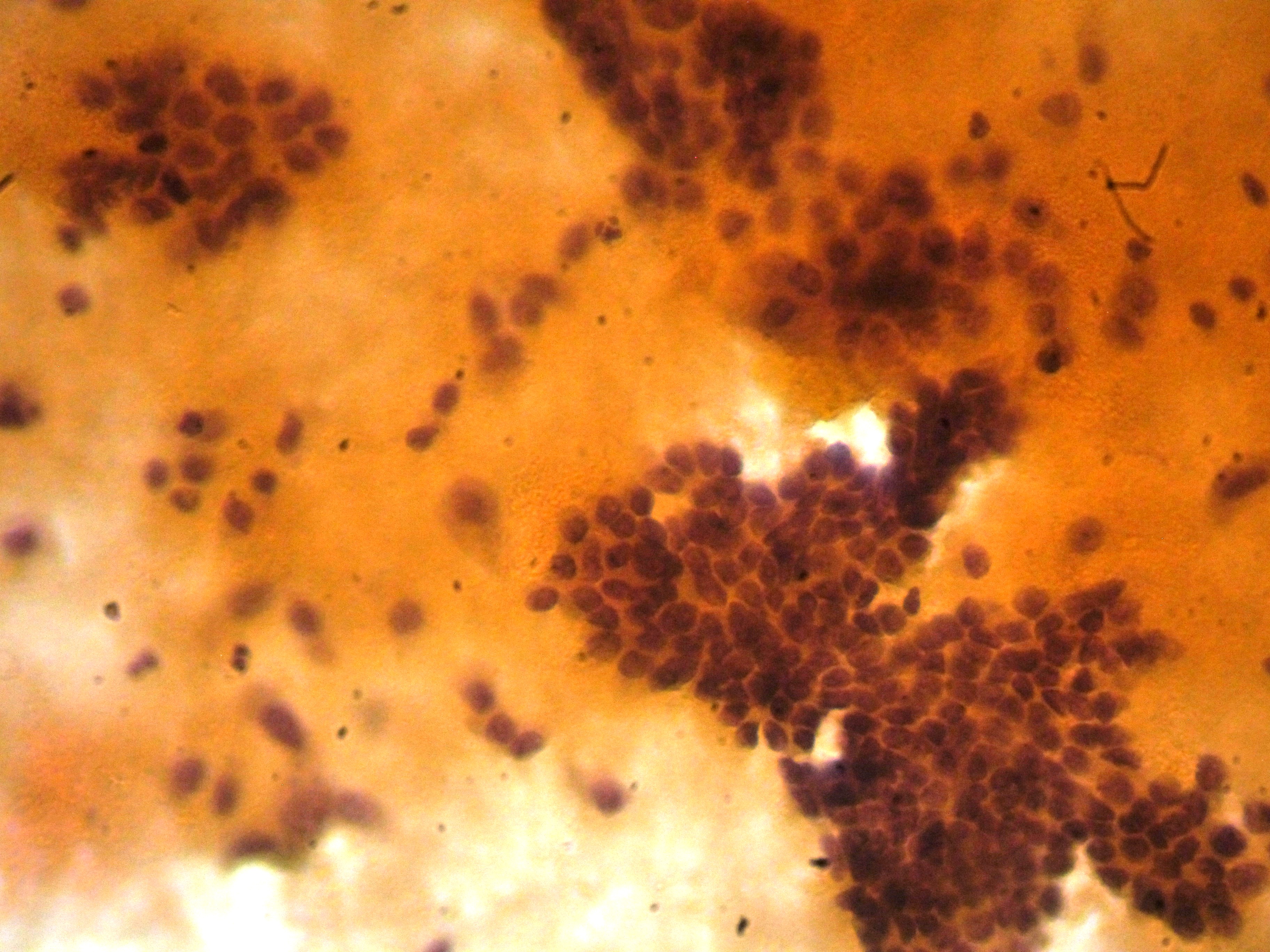 PAPILLARY THYROID CARCINOMA