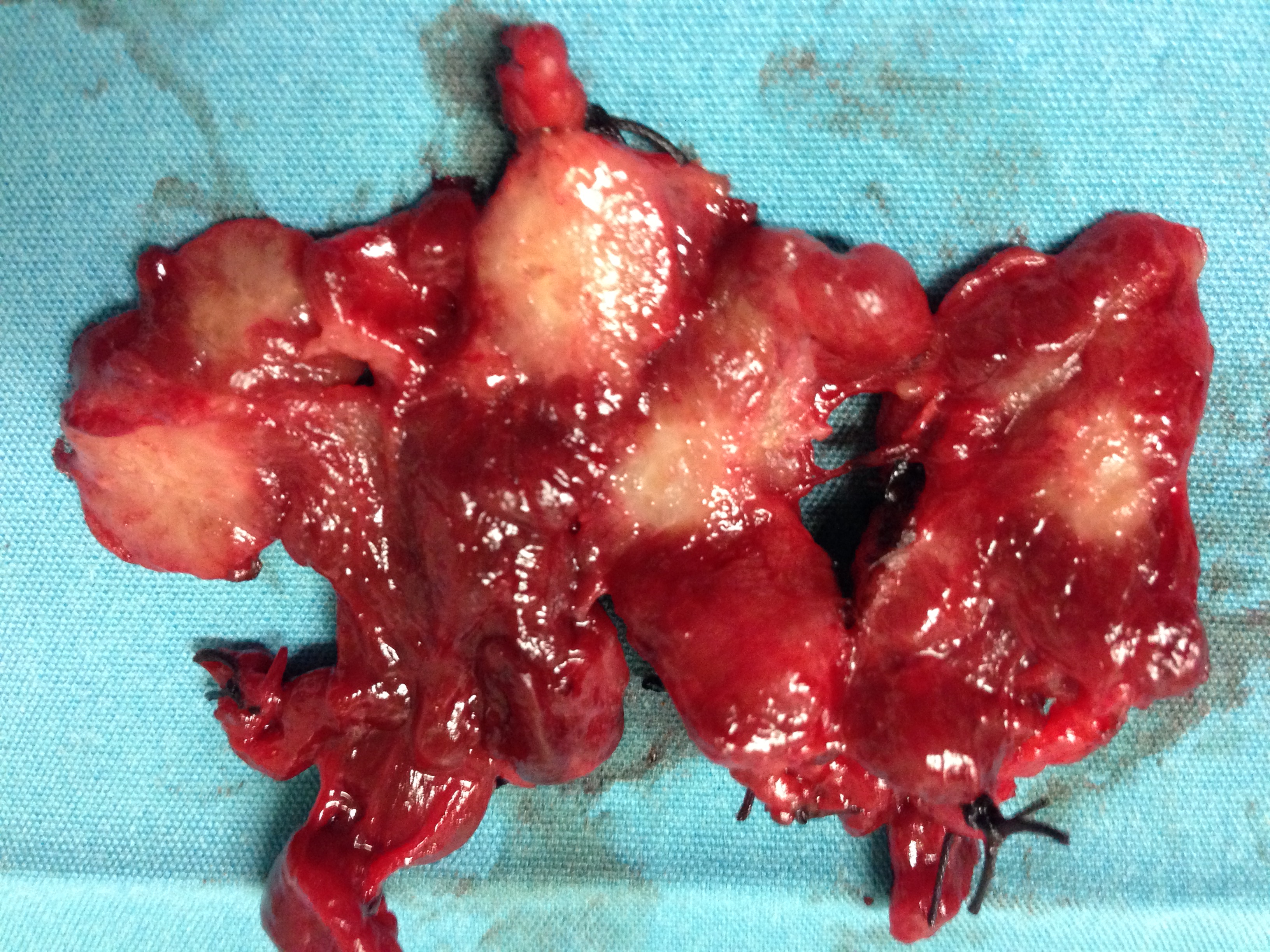 MULTIPLE PAPILLARY THYROID CARCINOMAS