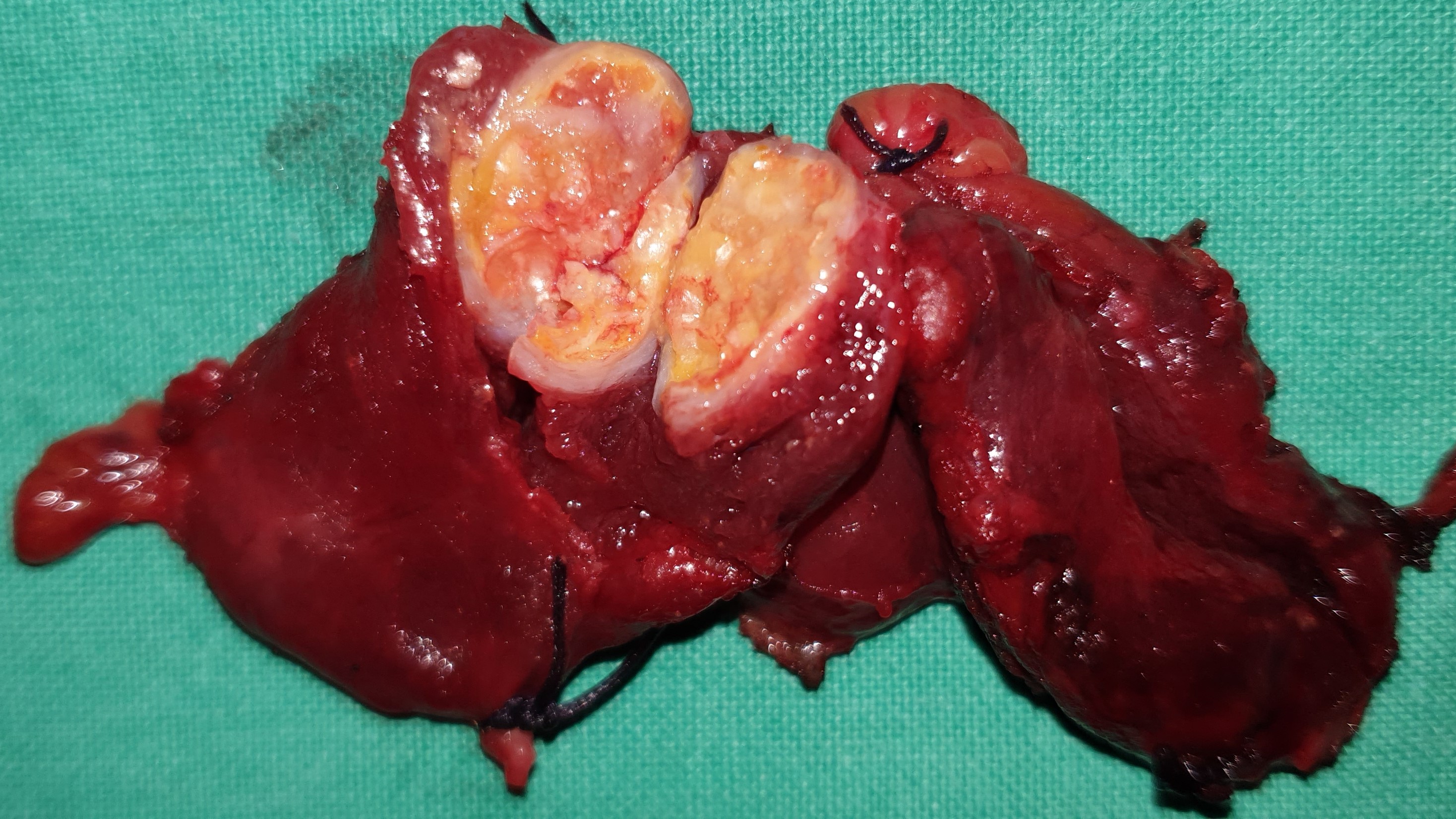 PAPILLARY THYROID CARCINOMA