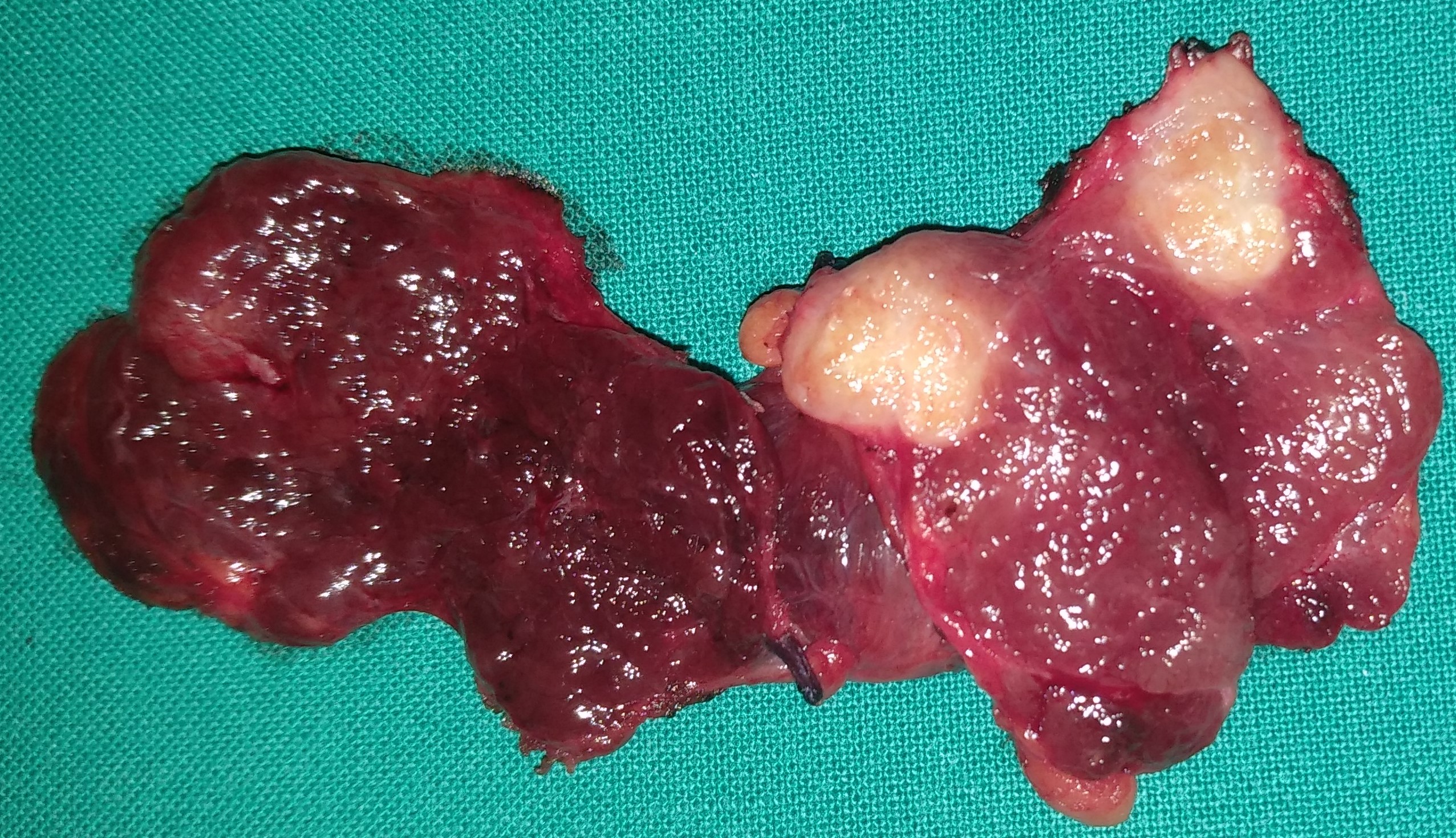PAPILLARY THYROID CARCINOMA