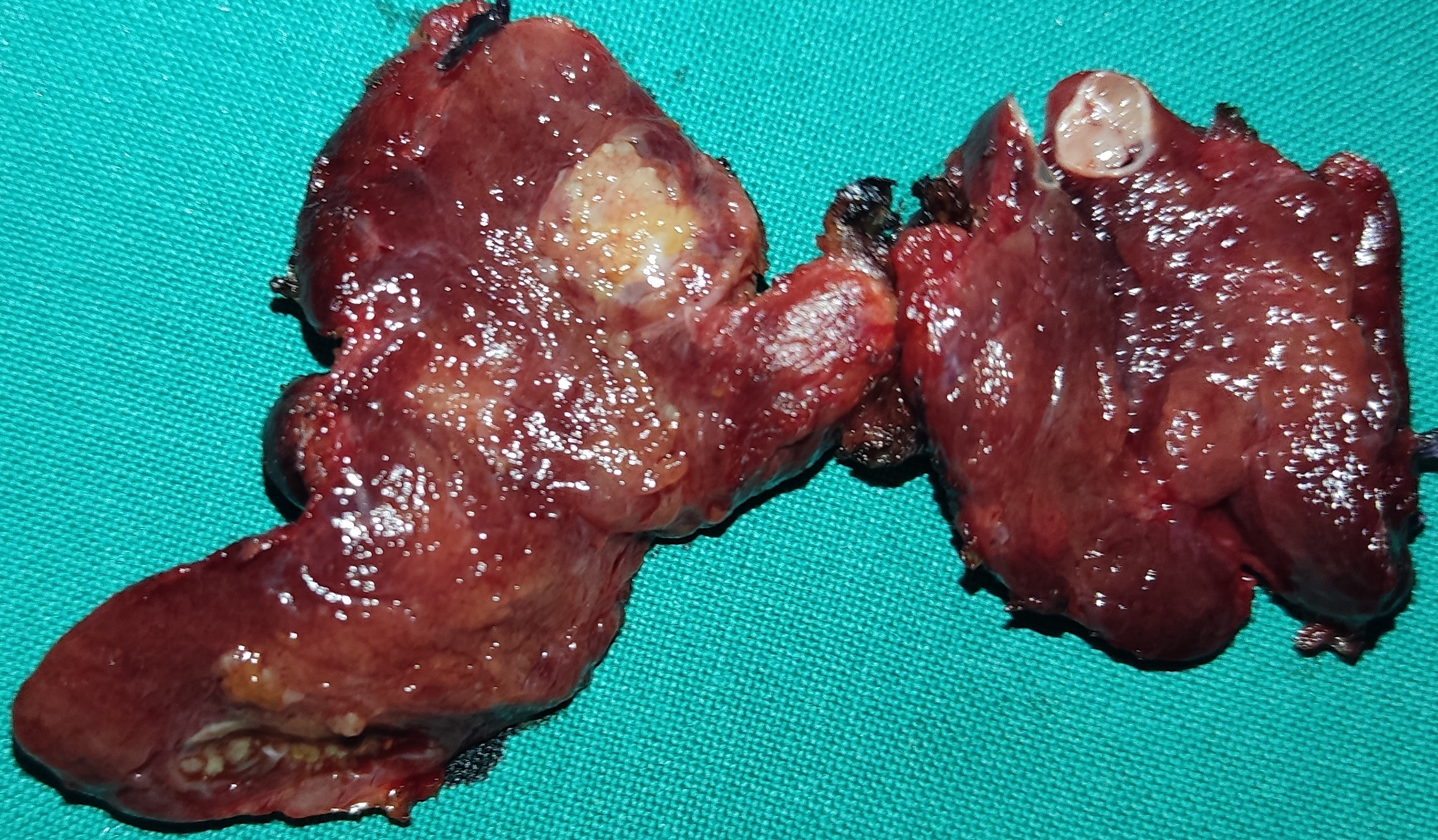 PAPILLARY THYROID CARCINOMA